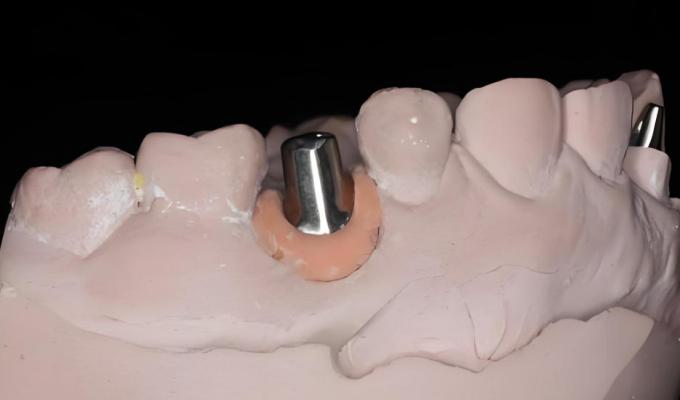 種植用個性化基臺冠橋廠家